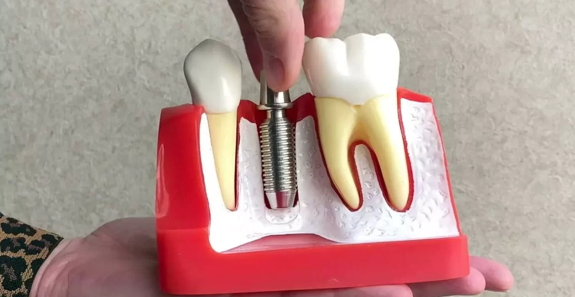 Advanced Dental Implant Techniques Used in Melbourne