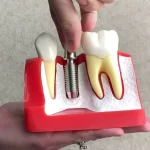 Advanced Dental Implant Techniques Used in Melbourne