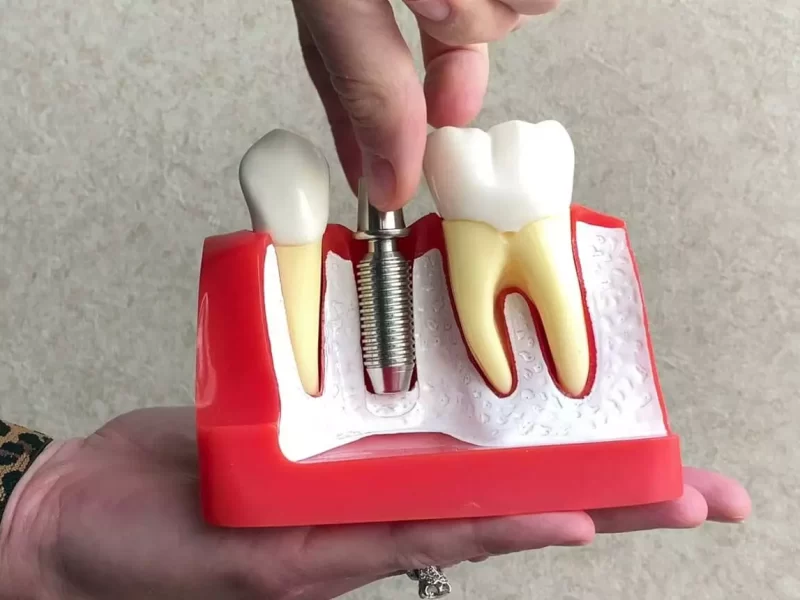 Advanced Dental Implant Techniques Used in Melbourne