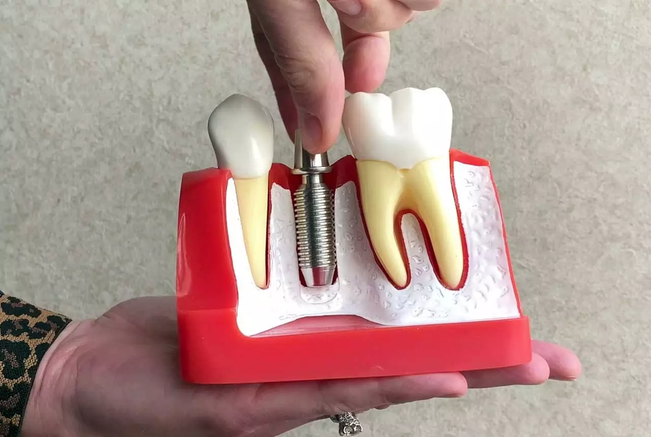 Advanced Dental Implant Techniques Used in Melbourne