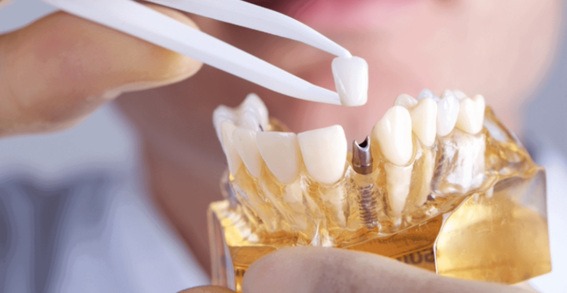 Exploring Emotional Connections with Dental Implants