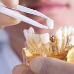 Exploring Emotional Connections with Dental Implants