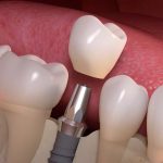 Biocompatibility Breakthroughs: Enhancing Dental Implant Integration