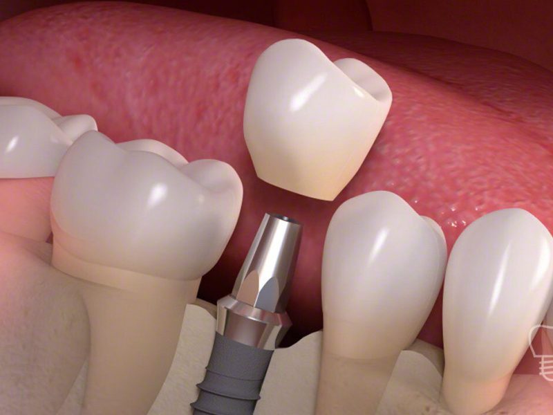 Biocompatibility Breakthroughs: Enhancing Dental Implant Integration