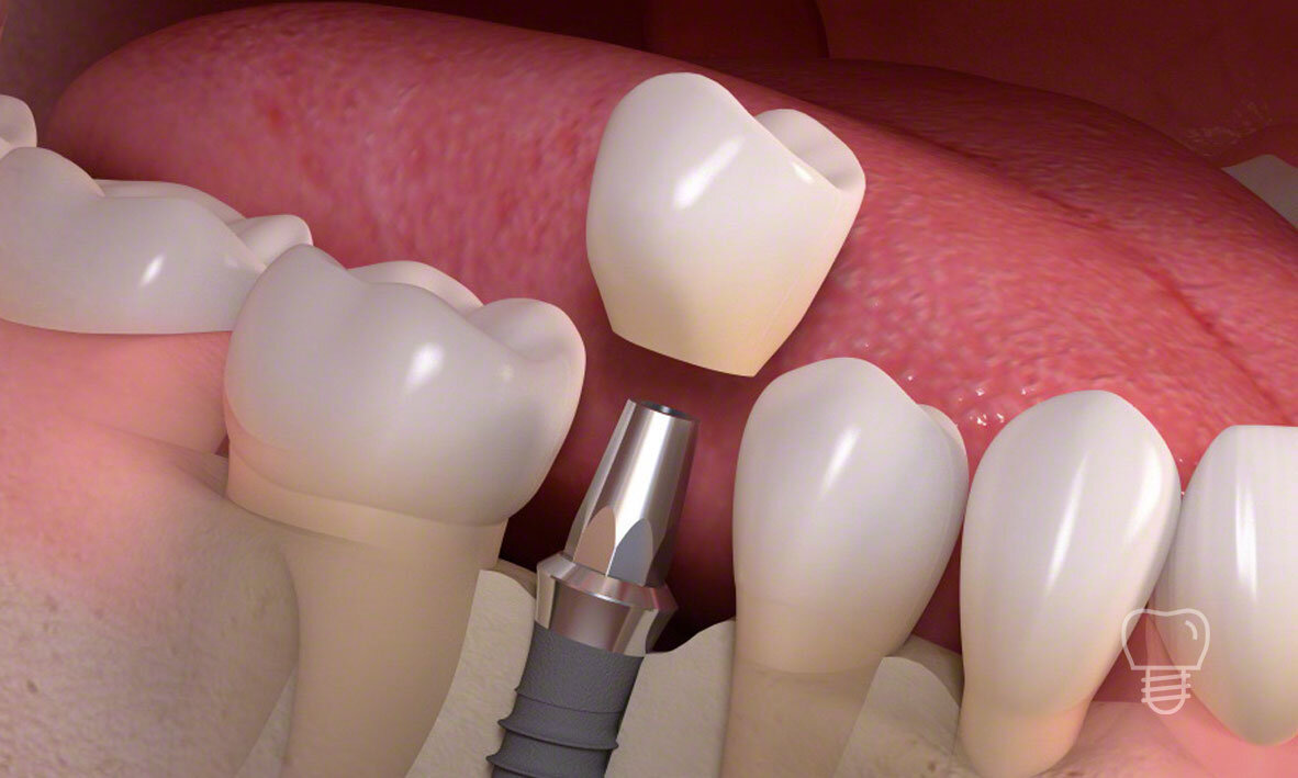 Biocompatibility Breakthroughs: Enhancing Dental Implant Integration