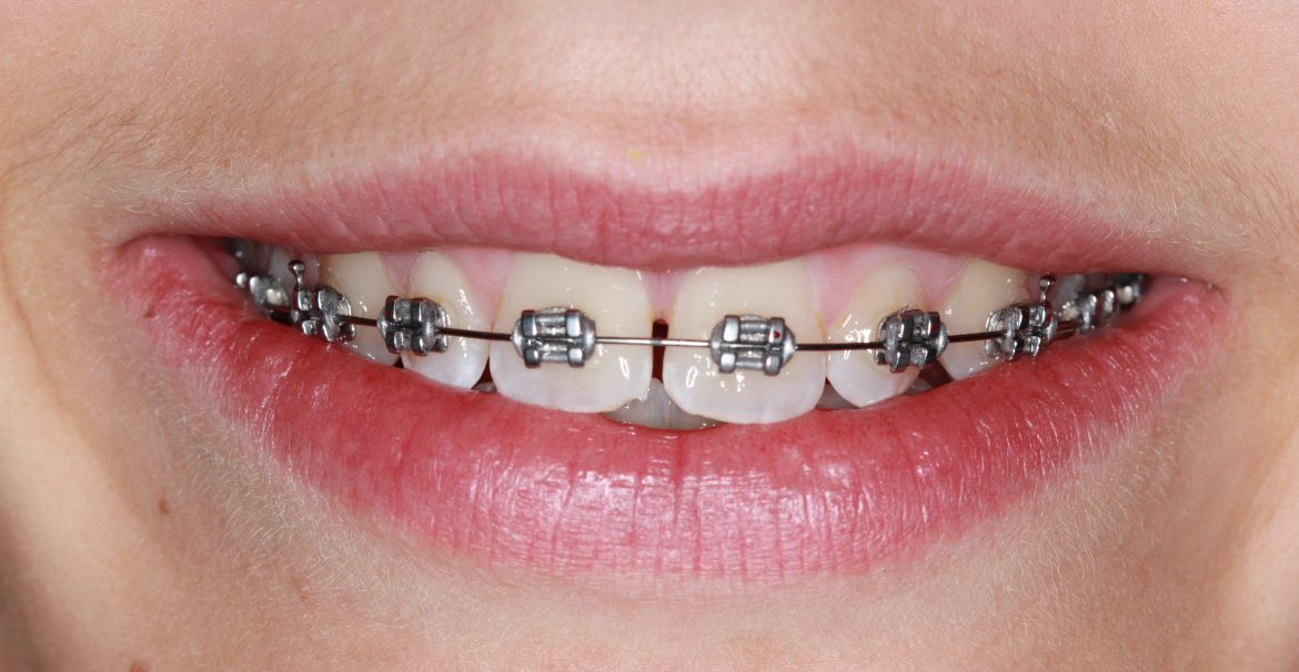 Braces and Nutrition: Optimising Your Diet for Better Results