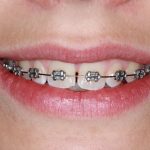 Braces and Nutrition: Optimising Your Diet for Better Results