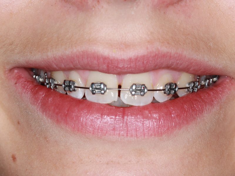 Braces and Nutrition: Optimising Your Diet for Better Results