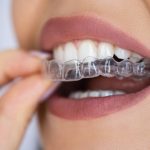 Discovering the Harmonious Blend of Technology and Comfort with Invisalign