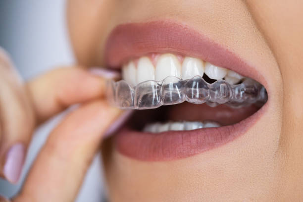 Discovering the Harmonious Blend of Technology and Comfort with Invisalign