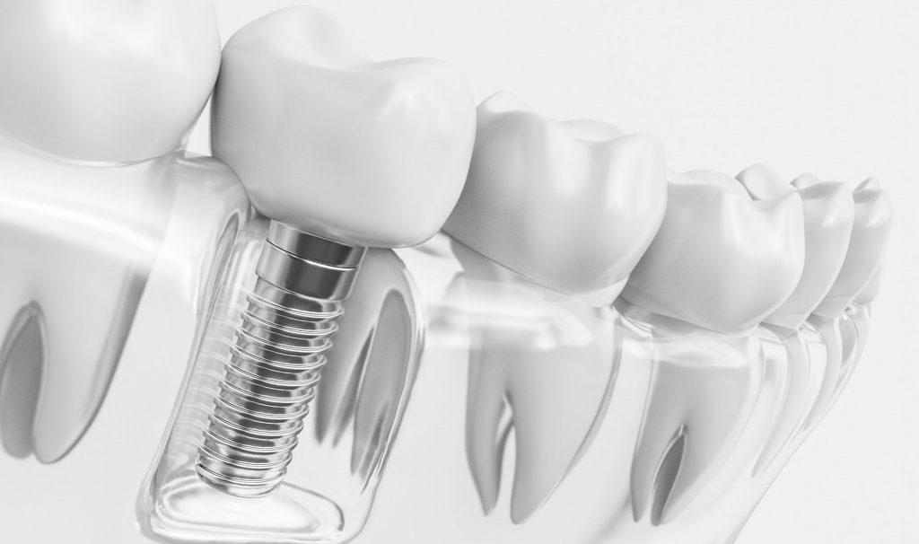 How Dental Implants Accelerate Healing Through Advanced Surface Technology
