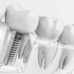 How Dental Implants Accelerate Healing Through Advanced Surface Technology