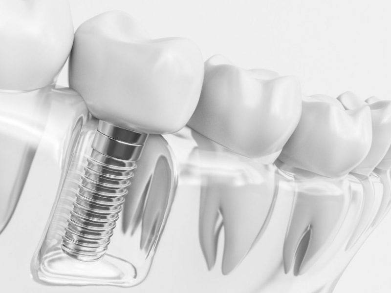 How Dental Implants Accelerate Healing Through Advanced Surface Technology