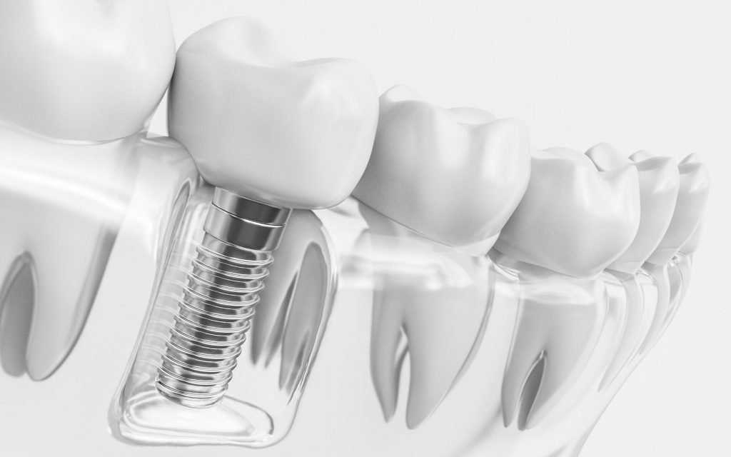 How Dental Implants Accelerate Healing Through Advanced Surface Technology