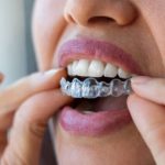 What Happens to Your Jawbone During Invisalign Treatment and Why It Matters