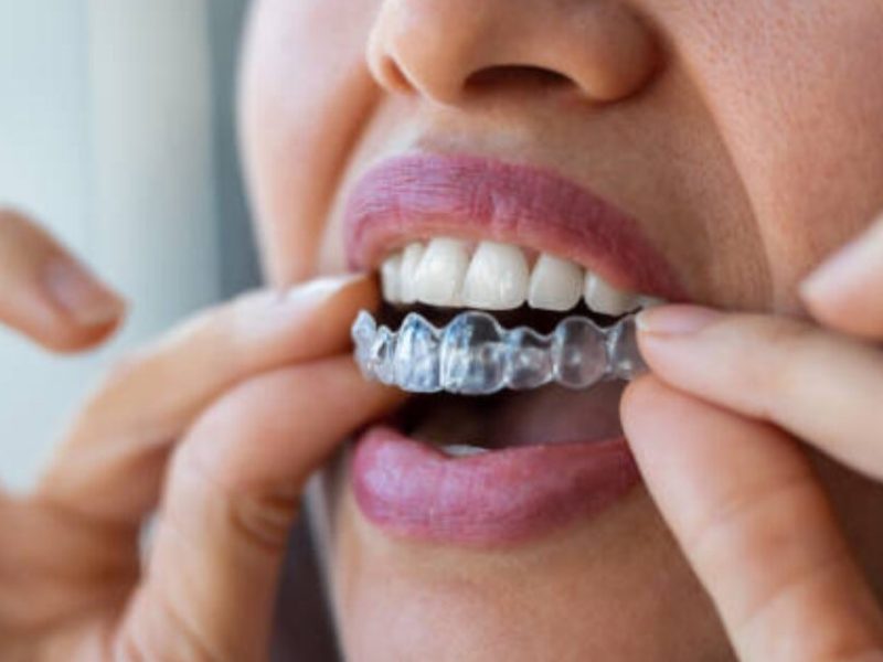What Happens to Your Jawbone During Invisalign Treatment and Why It Matters