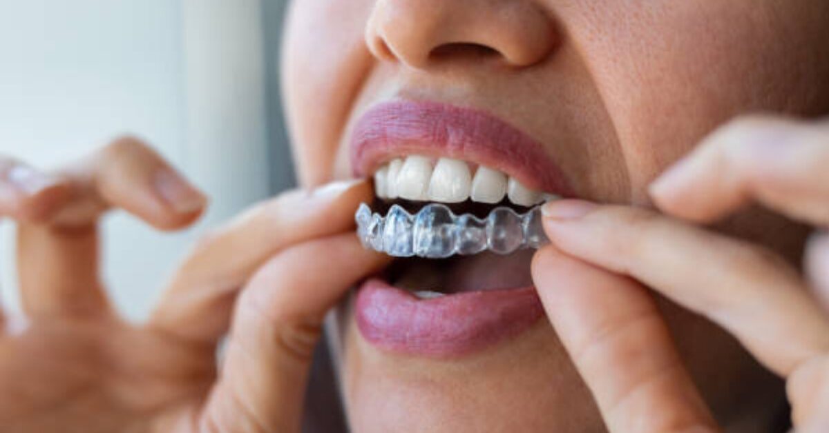 What Happens to Your Jawbone During Invisalign Treatment and Why It Matters